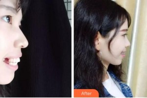 金華周亞軍口腔門診部周亞軍整形價格表附隱形托槽矯正案例展示