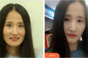 金華婁城口腔醫(yī)院彭濤整形價格表附牙齒陶瓷矯正案例展示