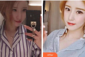 金華市人民醫(yī)院整形美容中心蔡陽群整形價格表附祛眼袋案例展示