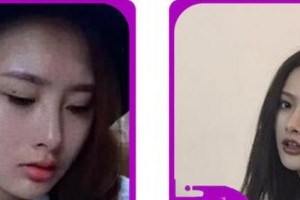 金華市人民醫(yī)院整形美容中心胡維君整形價格表附切開雙眼皮案例展示