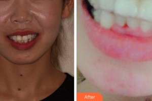 金華口腔醫(yī)院曹玲整形價格表附牙齒隱形矯正案例展示