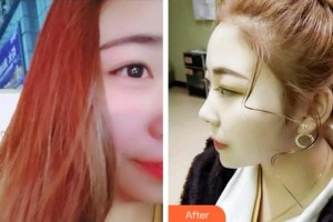 金華口腔醫(yī)院潘鵬程整形價格表附超聲波潔牙案例展示