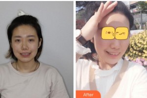 金華口腔醫(yī)院陳丹整形價格表附牙齒隱形矯正案例展示