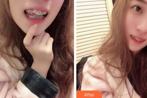 金華口腔醫(yī)院朱北蘭整形價格表附金屬托槽矯正案例展示