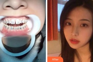 金華口腔醫(yī)院楊慶福整形價格表附隱形托槽矯正案例展示