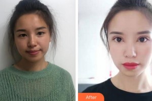 金華愛爾眼科醫(yī)院趙斌整形價格表附切開雙眼皮案例展示