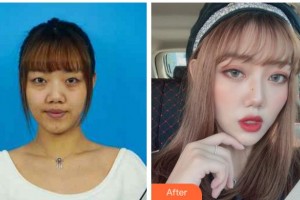 金華愛(ài)爾眼科醫(yī)院毛景璟整形價(jià)格表附切開(kāi)雙眼皮案例展示