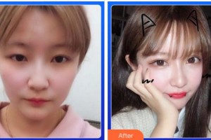 金華愛(ài)爾眼科醫(yī)院陳林勇整形價(jià)格表附埋線雙眼皮案例展示