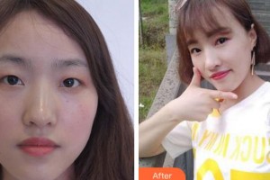 金華愛(ài)爾眼科醫(yī)院胡博磊整形價(jià)格表附切開(kāi)雙眼皮案例展示