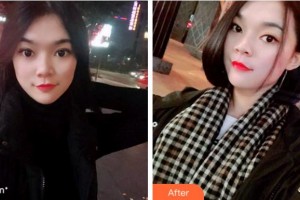 常州市口腔醫(yī)院趙金華整形價(jià)格表附牙齒隱形矯正案例展示