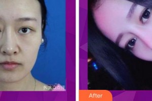 衢州美萊整形美容醫(yī)院黃盛高整形價(jià)格表附鼻部綜合案例展示