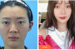 衢州美萊整形美容醫(yī)院陳愛(ài)云整形價(jià)格表附埋線提升案例展示