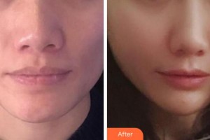 衢州民康醫(yī)院赫爾希整形美容中心張惠華整形價(jià)格表附埋線提升案例展示