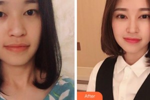 衢州芘麗芙整形美容醫(yī)院洪毓整形價(jià)格表附切開(kāi)雙眼皮案例展示