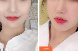 衢州芘麗芙整形美容醫(yī)院蔣小花整形價(jià)格表附埋線提升案例展示