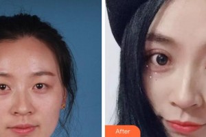 衢州芘麗芙整形美容醫(yī)院李威整形價(jià)格表附切開(kāi)雙眼案例展示