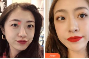 衢州愛(ài)爾眼科醫(yī)院荊樹(shù)棟整形價(jià)格表附眼部綜合案例展示