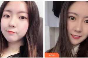 衢州愛爾眼科醫(yī)院張民軍整形價格表附切開雙眼皮案例展示