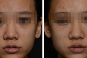 衢州愛爾眼科醫(yī)院李毓敏整形價格表附膠原蛋白填淚溝案例展示