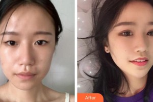 衢州愛爾眼科醫(yī)院周武英整形價格表附眼部整形案例展示