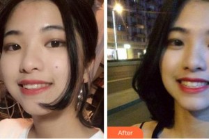 衢州寶爾口腔診所姜寶富整形價格表附牙齒隱形矯正案例展示