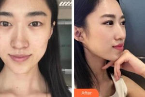 衢州市第二人民醫(yī)院眼科余曉峰整形價格表附眼部綜合案例展示