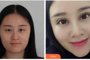 衢州市第二人民醫(yī)院眼科藍建文整形價格表附眼部綜合案例展示