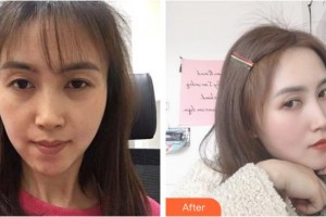 舟山沈虹醫(yī)療美容診所陸彥杰整形價格表附眼部綜合案例展示