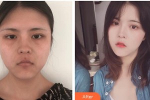 舟山港東醫(yī)療醫(yī)療美容診所季愛琴整形價格表附埋線提升案例展示