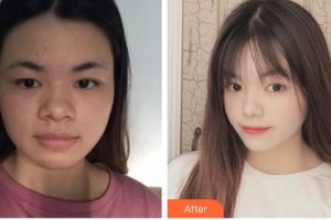 舟山妃斯醫(yī)療美容門診部李艷蓮整形價格表附埋線提升案例展示