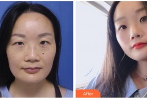 舟山市定海區(qū)中心醫(yī)院眼科王舟盛整形價格表附祛眼袋案例展示