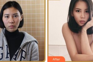 臺州新鳳凰醫(yī)學(xué)整形美容醫(yī)院陳國忠整形價格表附眼部綜合案例展示