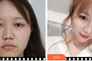 臺州新鳳凰醫(yī)學(xué)整形美容醫(yī)院井顯廉整形價格表附耳軟骨復(fù)合隆鼻案例展示