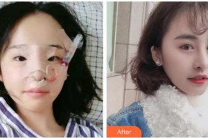 臺州新鳳凰醫(yī)學(xué)整形美容醫(yī)院張敬德整形價格表附鼻部綜合案例展示