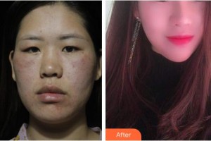 臺州博雅美惠醫(yī)療美容整形醫(yī)院占潔整形價格表附鼻部綜合案例展示