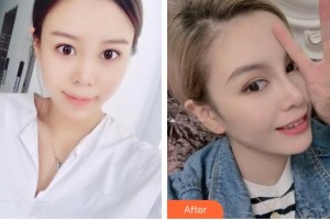 臺州維多利亞整形美容醫(yī)院王永展整形價格表附假體隆鼻案例展示