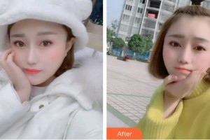 臺州市博愛醫(yī)院整形美容科王肖琴整形價格表附金屬托槽矯正案例展示