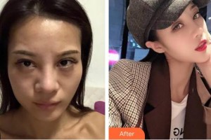 臺州華美整形美容醫(yī)院何萍整形價格表附肋軟骨隆鼻案例展示