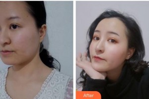 臺(tái)州維多利亞整形美容醫(yī)院劉燕玉整形價(jià)格表附埋線提升案例展示