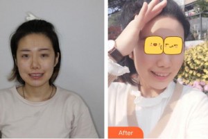 臺(tái)州維多利亞整形美容醫(yī)院藍(lán)?；壅蝺r(jià)格表附牙齒隱形矯正案例展示