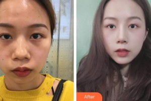 臺(tái)州臨海市蔣氏美容整形外科診所蔣未臺(tái)整形價(jià)格表附鼻部綜合案例展示