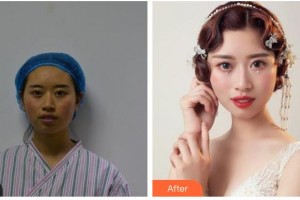 臺(tái)州市中心醫(yī)院整形美容科陶革方整形價(jià)格表附埋線提升案例展示