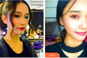 臺(tái)州歐亞整形醫(yī)院占鈺整形價(jià)格表附熱瑪吉案例展示