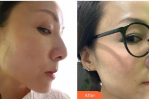 臺(tái)州維多利亞整形美容醫(yī)院張曉娟整形價(jià)格表附埋線提升案例展示