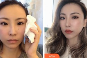 臺(tái)州維多利亞整形美容醫(yī)院尹建蘭整形價(jià)格表附埋線提升案例展示