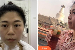 臺州愛美美萊醫(yī)療美容門診部趙德明整形價格表附熱瑪吉案例展示