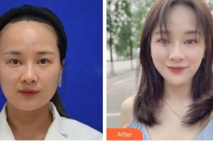 臺州仁登醫(yī)療美容門診部陳道明整形價格表附埋線提升案例展示