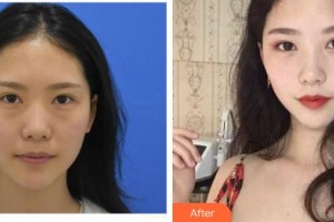 臺州恩璨醫(yī)療美容門診部曠健整形價格表附激光去眼袋案例展示