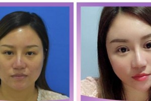 臺州恩璨醫(yī)療美容門診部汪堡壘整形價格表附激光去眼袋案例展示