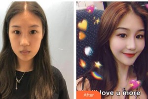 臺州國際眼科醫(yī)院陳世豪整形價格表附定點(diǎn)雙眼皮案例展示